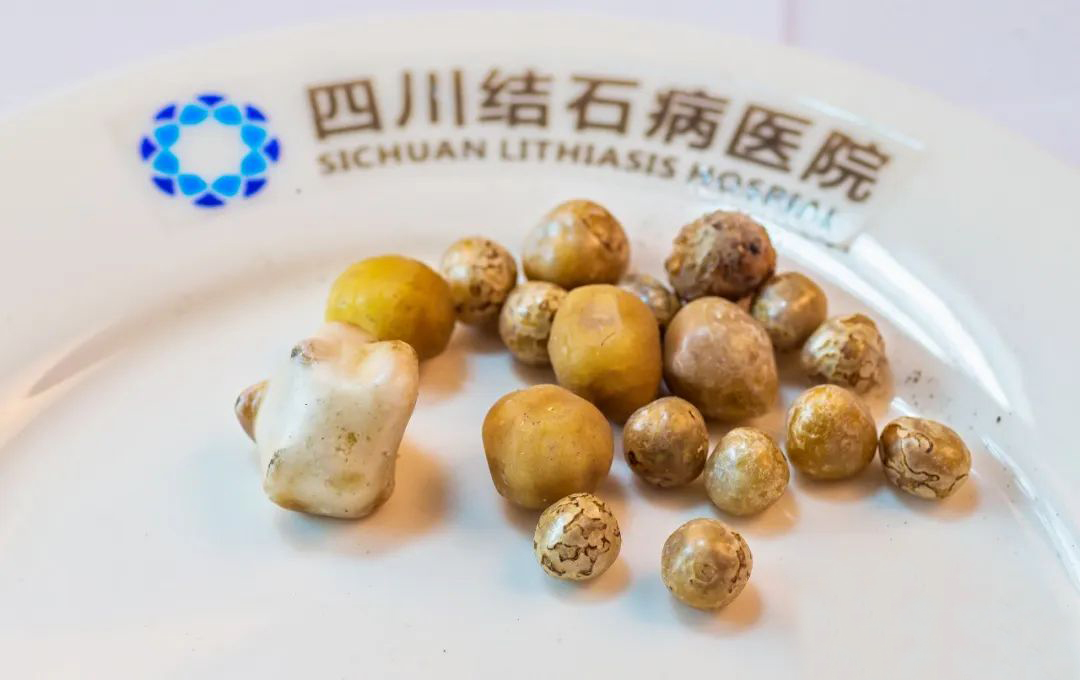 不想切胆,6、70岁的胆结石患者就只能熬?专家说,80岁都不用熬!(图4) 不想切胆,6、70岁的胆结石患者就只能熬?专家说,80岁都不用熬!(图4)