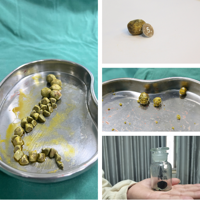 全力以赴，医有保障！四川结石病医院积极应对春季胆结石就诊高峰(图2)