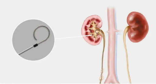 聚焦共识学习赋能:四川结石病医院开展输尿管支架管专家共识解读培训会(图3) 聚焦共识学习赋能:四川结石病医院开展输尿管支架管专家共识解读培训会(图3)