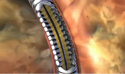 聚焦共识学习赋能:四川结石病医院开展输尿管支架管专家共识解读培训会(图4) 聚焦共识学习赋能:四川结石病医院开展输尿管支架管专家共识解读培训会(图4)