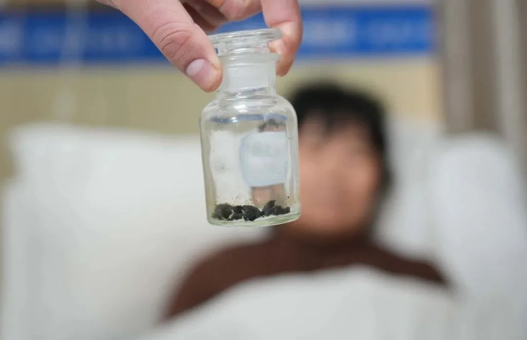 四川保胆案例分享:亲家母保胆八年后结石无再生,她也来圆保胆梦!(图1) 四川保胆案例分享:亲家母保胆八年后结石无再生,她也来圆保胆梦!(图1)