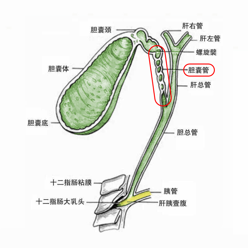 胆囊切除了，是不是就不会再长结石了？关于胆囊结石的真相在这里(图2)