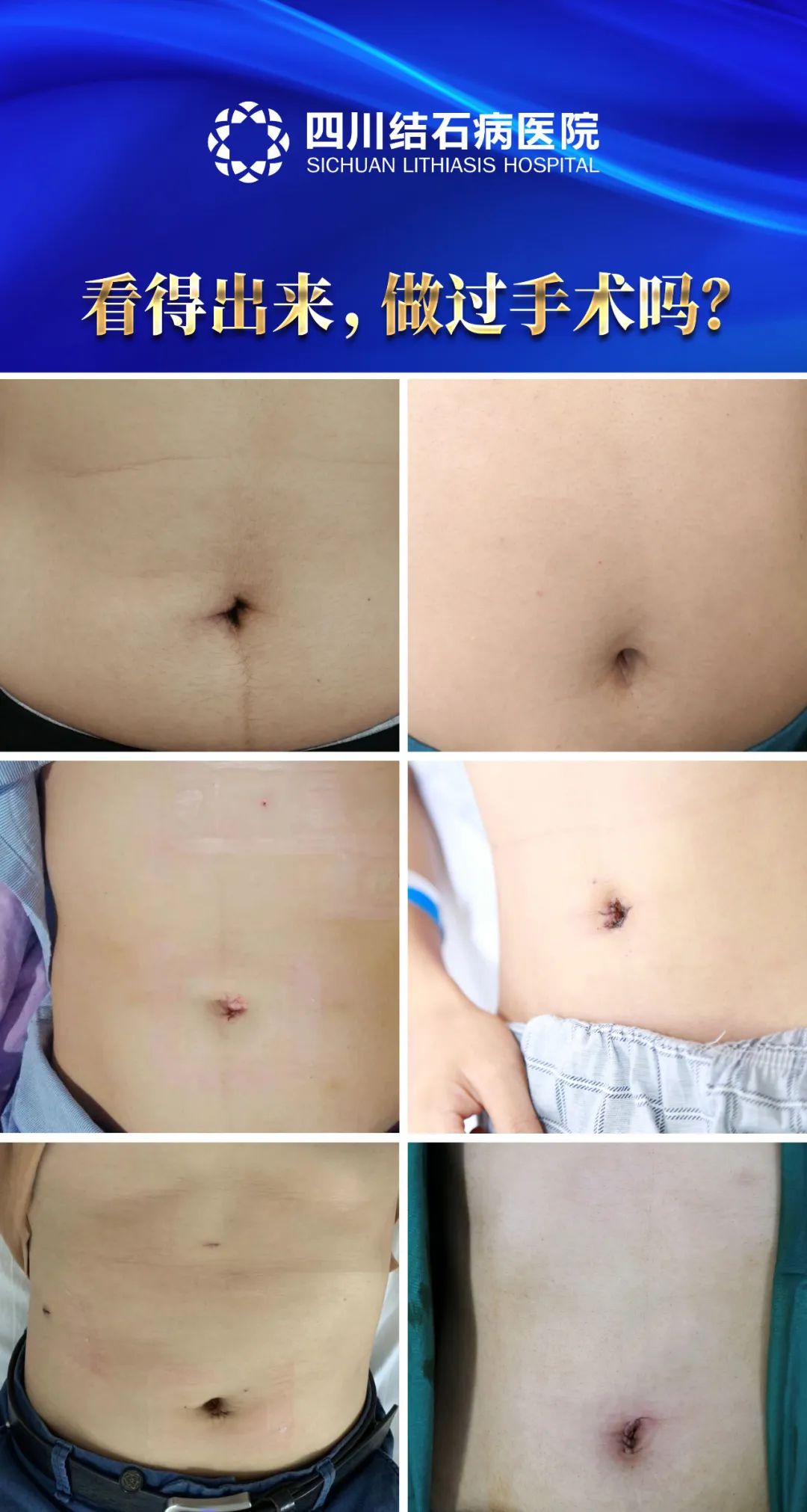 「成都胆结石医院」家门口即可享受保胆取石“国之名医”亲诊+手术(图2)