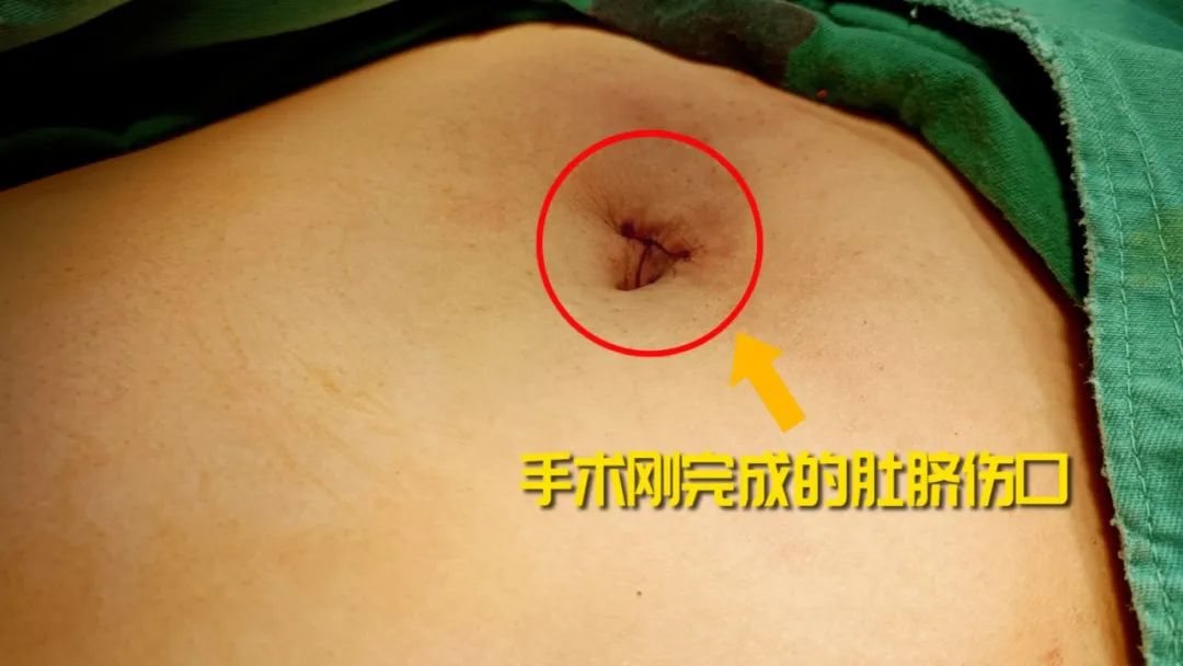 探访直击：四川结石病医院“隐形保胆”技术！「全国保胆取石基地」(图1)