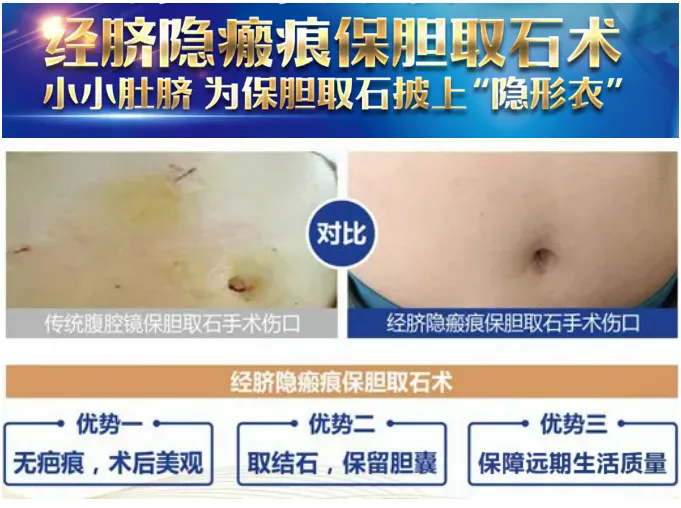 硬实力！四川结石病医院领跑隐痕保胆技术，保胆取石+疤痕隐形！(图3)