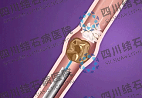 成都治疗肾结石需要多少钱？四川结石病医院详解费用构成(图2)
