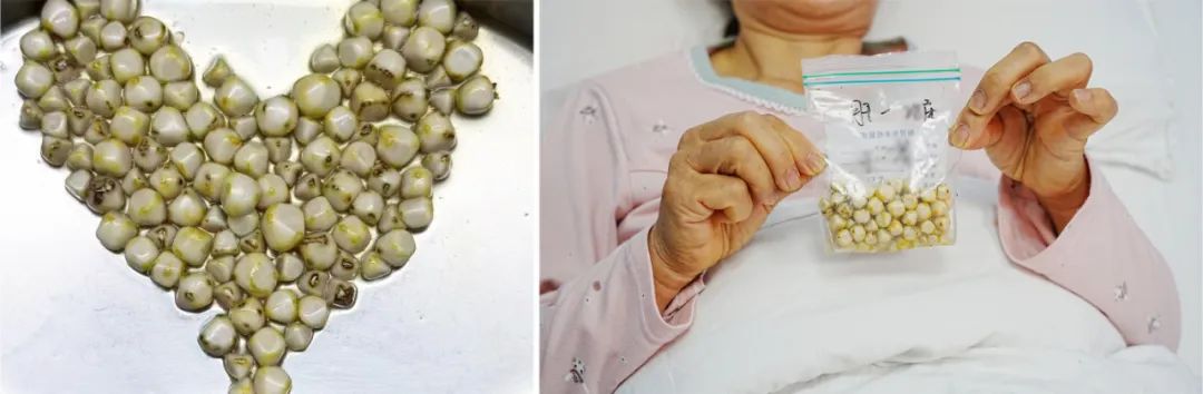 57岁教师面对“结石危机”，猜猜他选保胆还是切胆？【四川结石病专科医院】(图3)