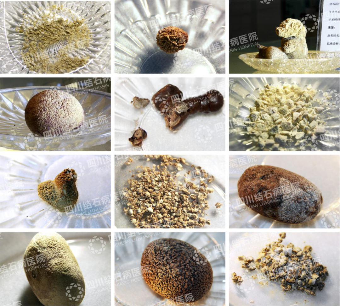 建议收藏！肾结石患者最关心的8大问题，一次性讲清楚！【四川肾结石专科医院】(图7)