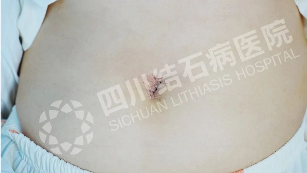 幼儿园大厨的“脐”遇：圆梦保胆，不留手术痕迹【四川保胆取石案例】(图1)