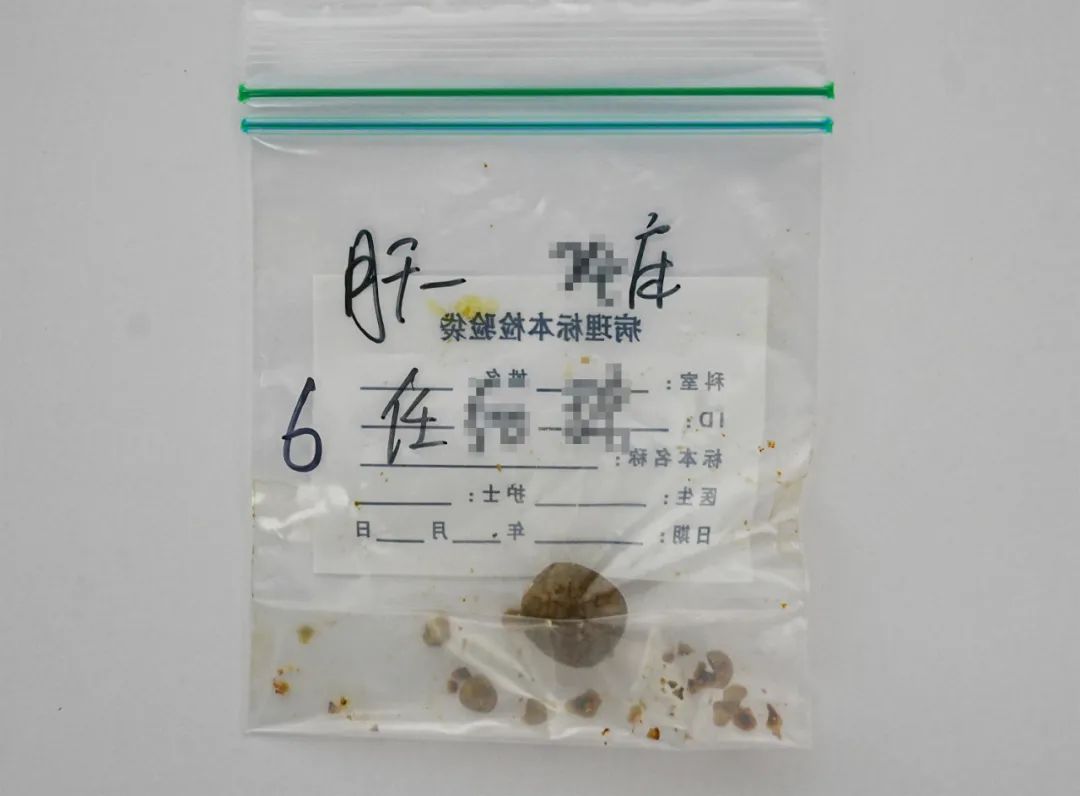 幼儿园大厨的“脐”遇：圆梦保胆，不留手术痕迹【四川保胆取石案例】(图2)