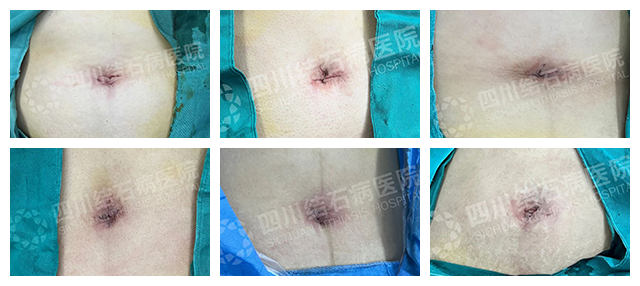 幼儿园大厨的“脐”遇：圆梦保胆，不留手术痕迹【四川保胆取石案例】(图4)