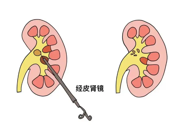 患者关注：肾结石术后多久能恢复？从手术区别到恢复周期，一篇讲明白！【四川结石病专科医院】(图3)
