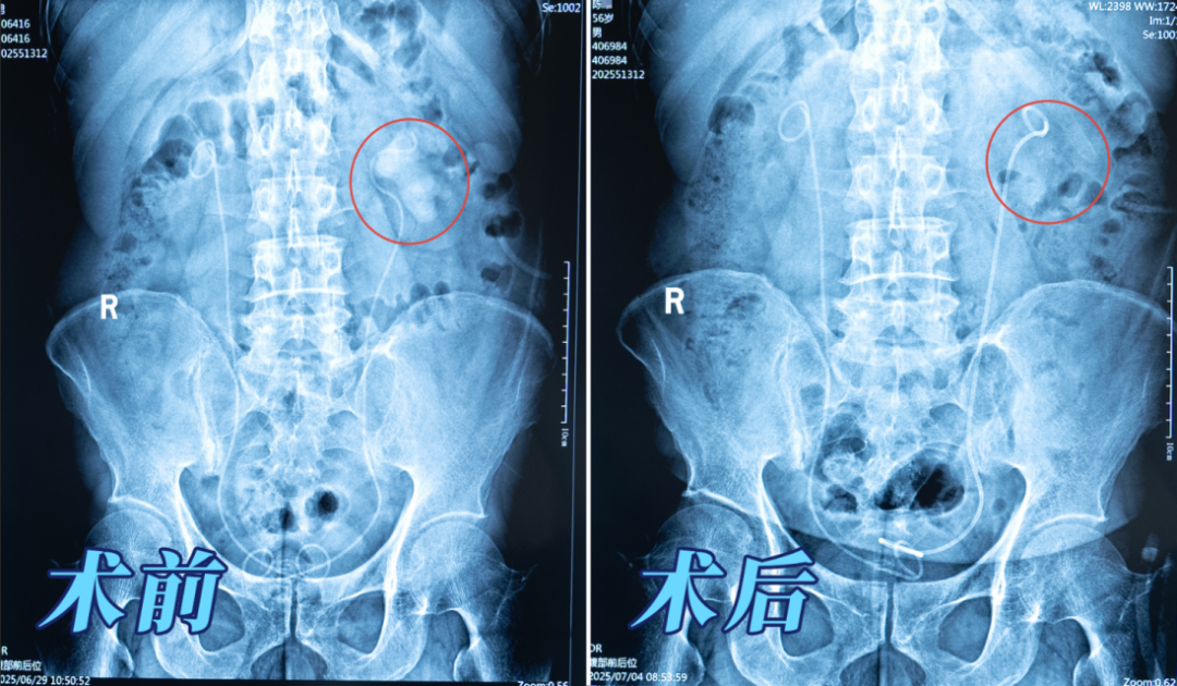 案例分享：又见“巨无霸”！男子肾脏取出8公分铸型结石【四川肾结石专科医院】(图1)