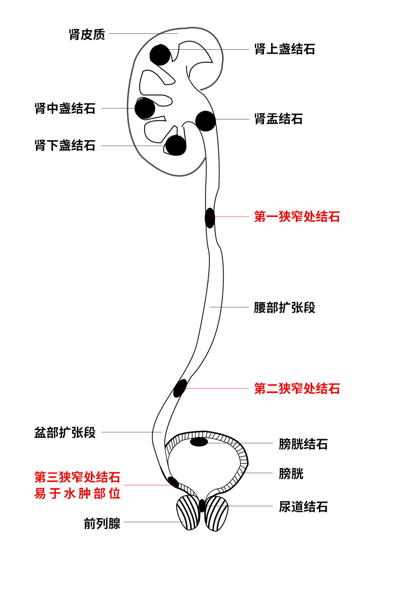 输尿管结石与狭窄：藏在体内的“恶性循环”，背后关系大揭秘！(图3)