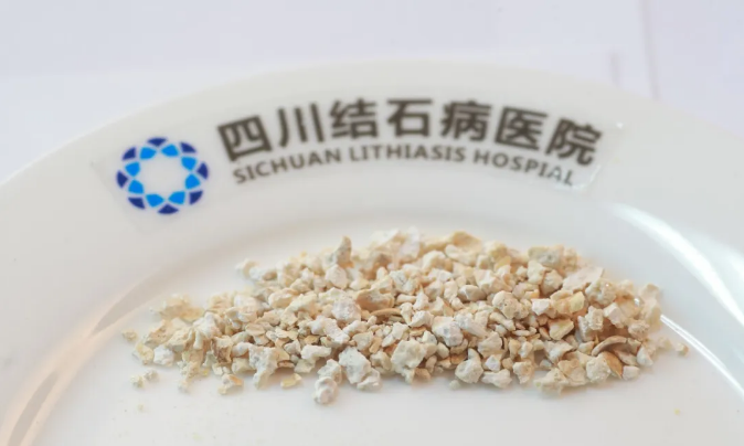 肾结石碎石后多久能排出来？这些因素决定排出速度【成都24小时碎石医院 】(图2)