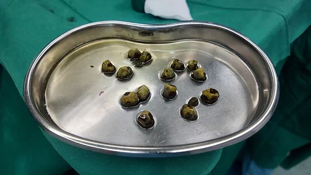 胆囊结石想靠碎石排石？四川结石病医院陈红春主任：此路行不通，别踩坑！(图3)