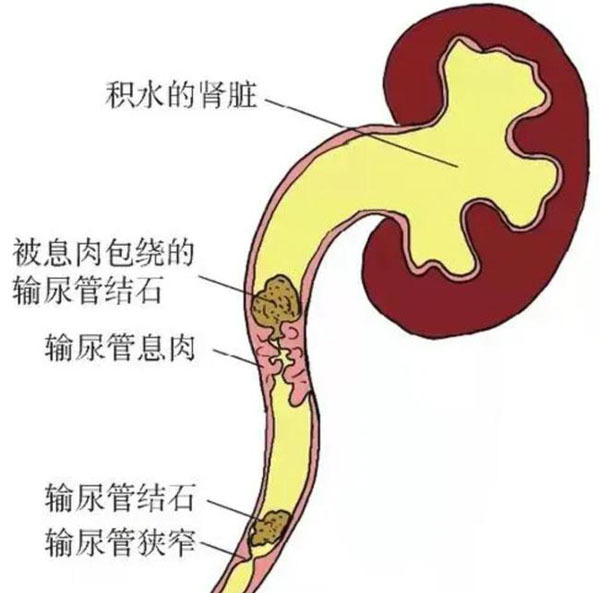 结石手术做了白做,反正还会长?泌尿外科专家提醒:别让误解耽误了健康!(图3) 结石手术做了白做,反正还会长?泌尿外科专家提醒:别让误解耽误了健康!(图3)