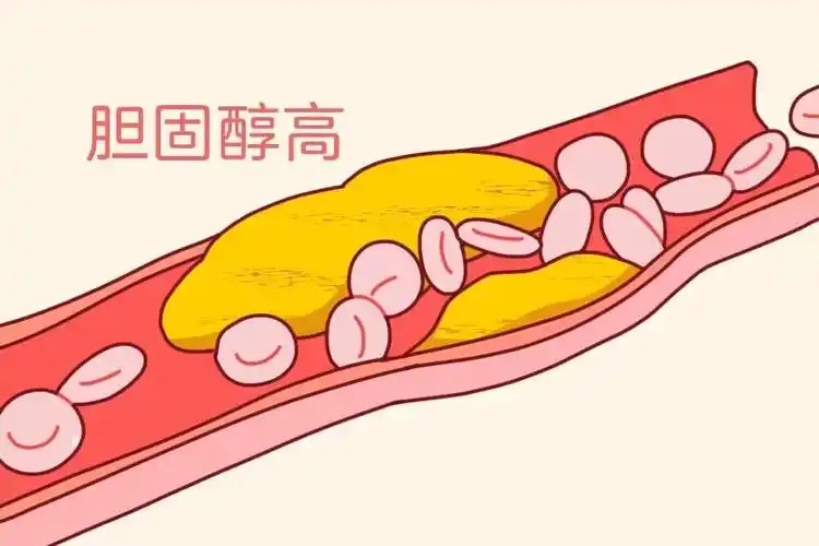 脂肪的双刃剑:是胆囊守护者,还是结石帮凶?【成都哪里能保胆取石】(图2) 脂肪的双刃剑:是胆囊守护者,还是结石帮凶?【成都哪里能保胆取石】(图2)