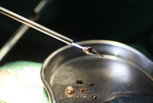 肾结石悄然演变的“五步惊魂”:早发现、早干预是关键【成都治疗肾结石医院】(图3) 肾结石悄然演变的“五步惊魂”:早发现、早干预是关键【成都治疗肾结石医院】(图3)