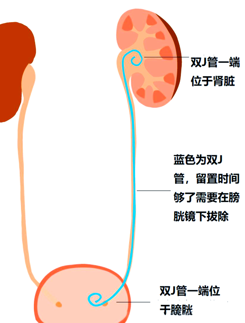 肾结石术后必知干货:双J管的作用、留置时间与3个关键注意事项!【四川肾结石专科医院】(图2) 肾结石术后必知干货:双J管的作用、留置时间与3个关键注意事项!【四川肾结石专科医院】(图2)