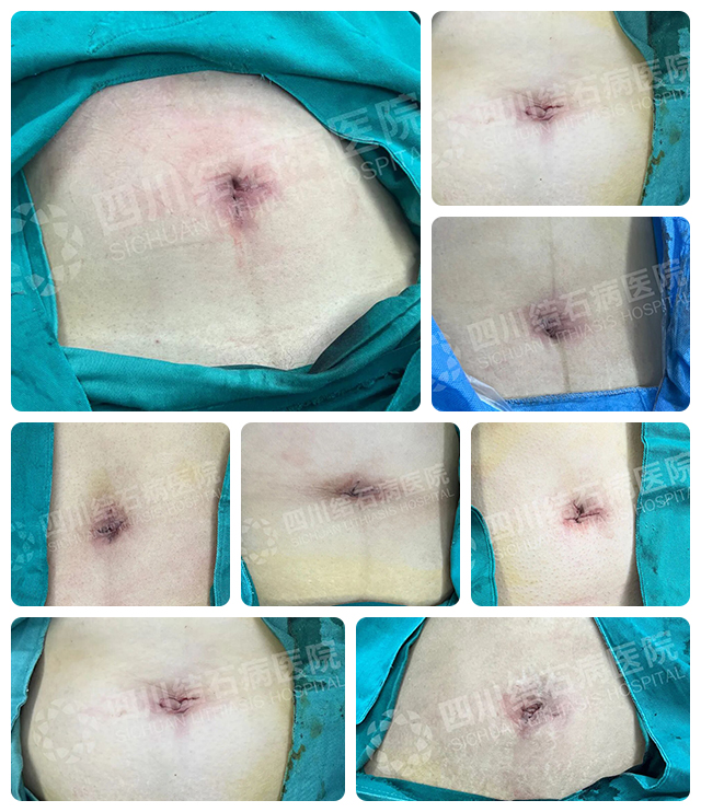 四川结石病医院经脐保胆技术获国家级认可,国庆中秋接诊不打烊(图4) 四川结石病医院经脐保胆技术获国家级认可,国庆中秋接诊不打烊(图4)