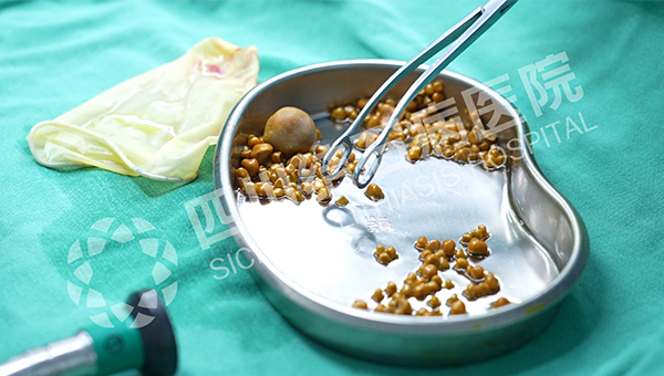 无症状≠无风险!40岁女子突发腹痛,四川结石病医院保胆取出275颗结石(图4) 无症状≠无风险!40岁女子突发腹痛,四川结石病医院保胆取出275颗结石(图4)