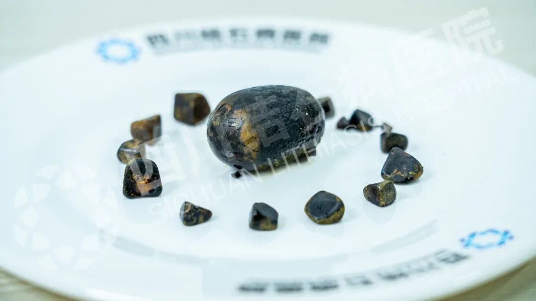 国庆聚餐后突发剧痛!成都女子保胆取出4厘米“鸽子蛋”结石【四川胆结石医院】(图2) 国庆聚餐后突发剧痛!成都女子保胆取出4厘米“鸽子蛋”结石【四川胆结石医院】(图2)