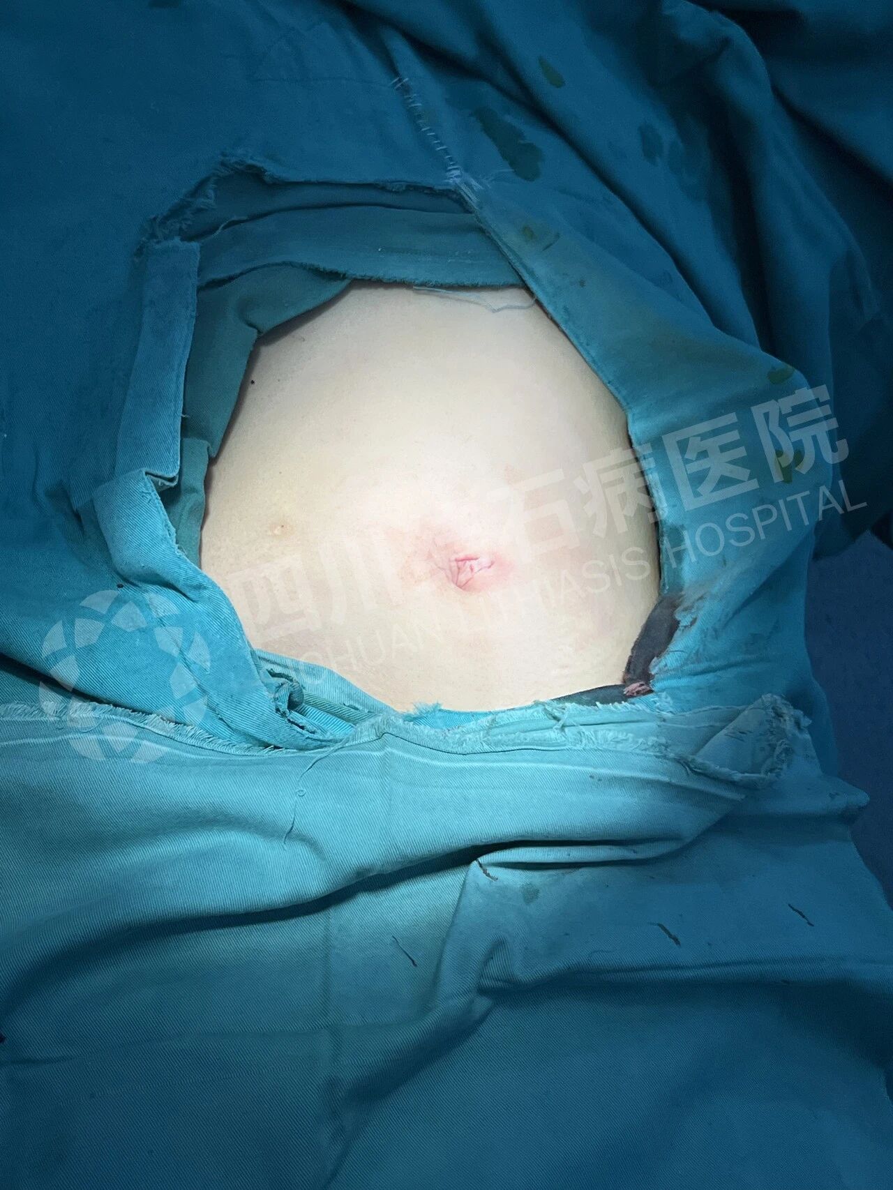 怕留疤?怕切胆?经脐隐瘢痕技术实现“鱼与熊掌兼得”【四川结石病医院】(图3) 怕留疤?怕切胆?经脐隐瘢痕技术实现“鱼与熊掌兼得”【四川结石病医院】(图3)