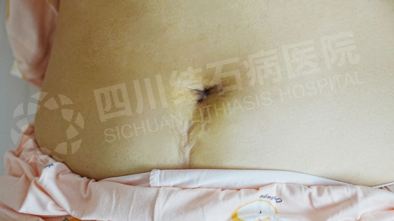 怕留疤?怕切胆?经脐隐瘢痕技术实现“鱼与熊掌兼得”【四川结石病医院】(图6) 怕留疤?怕切胆?经脐隐瘢痕技术实现“鱼与熊掌兼得”【四川结石病医院】(图6)