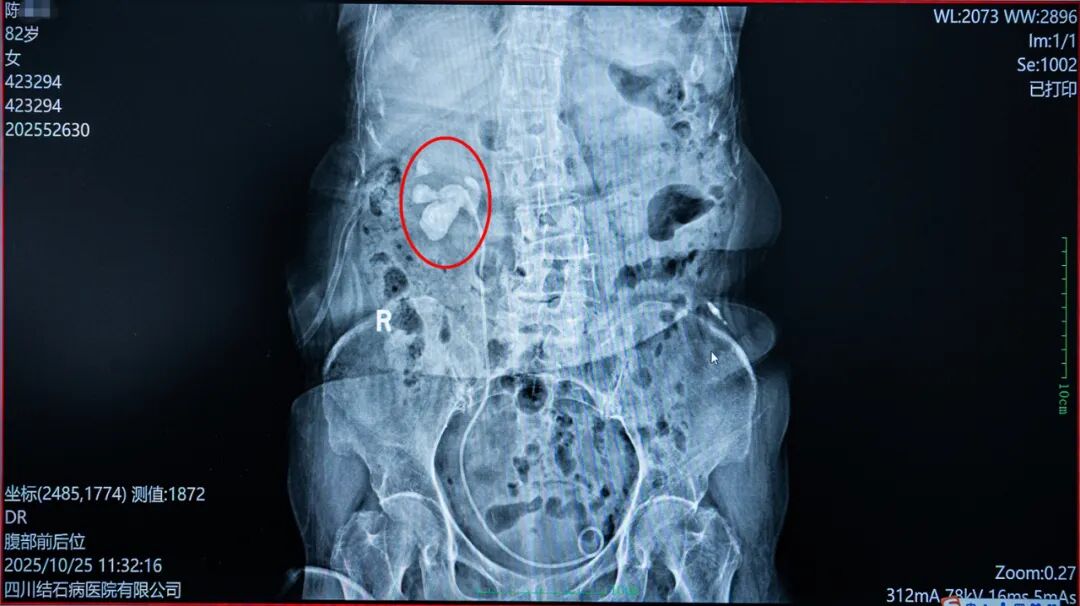 八旬奶奶“除石”记：当右肾铸型结石遇上医者仁心【四川结石病医院】(图2)