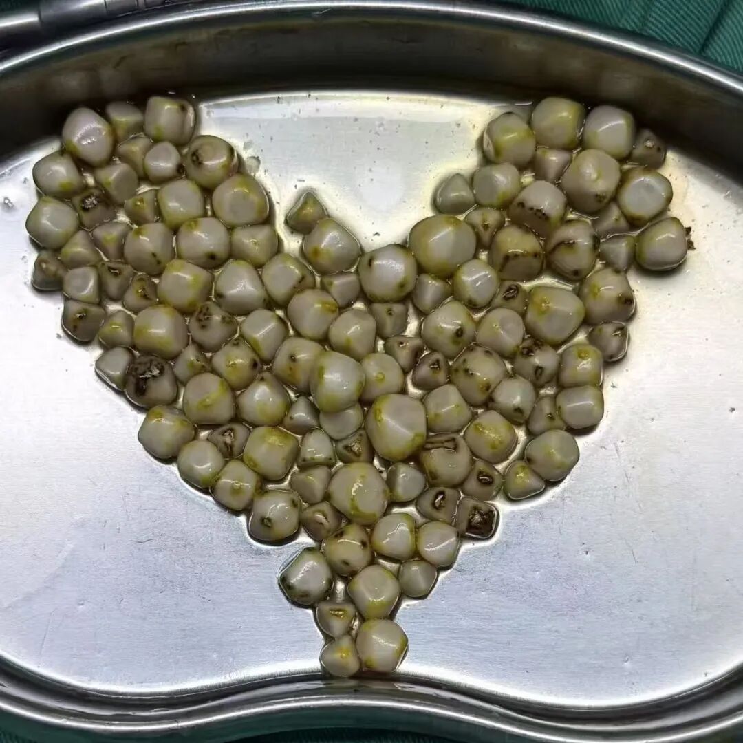 2025年度|四川结石病医院肝胆外科:深耕亚专科,绘就精准医疗蓝图(图2) 2025年度|四川结石病医院肝胆外科:深耕亚专科,绘就精准医疗蓝图(图2)