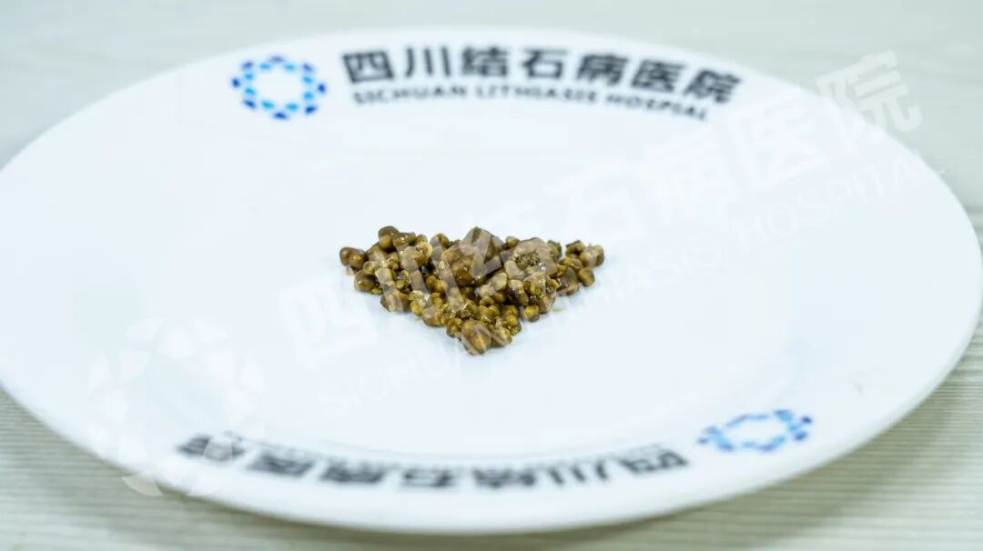 腹部不适不重视，一顿腊肉香肠把她送进医院【四川胆结石专科医院】(图2)