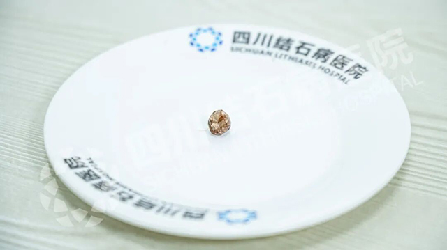 18岁就失去一个器官 这个习惯很多人都有【四川胆结石医院】(图2)