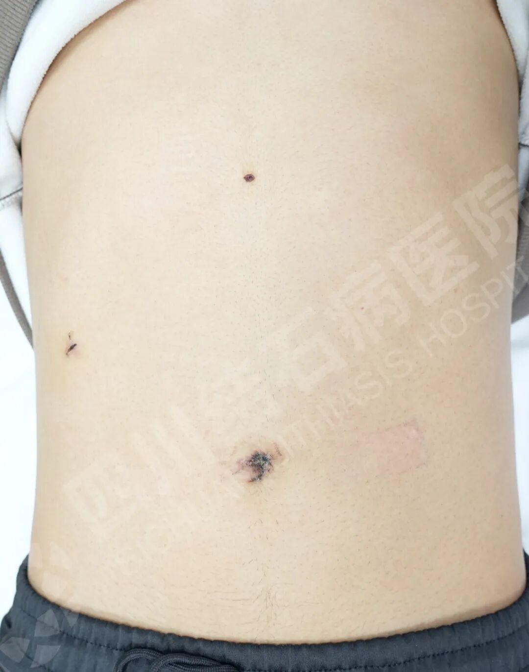 88颗结石“鸠占鹊巢”？四川结石病医院经脐超微创一招取出(图2)