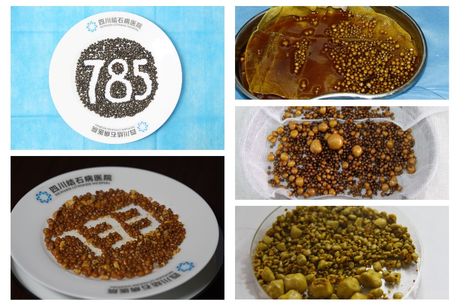 超60%患者是女性！这场无声的健康危机，正悄然逼近每一个“她”【四川结石病医院】(图1)