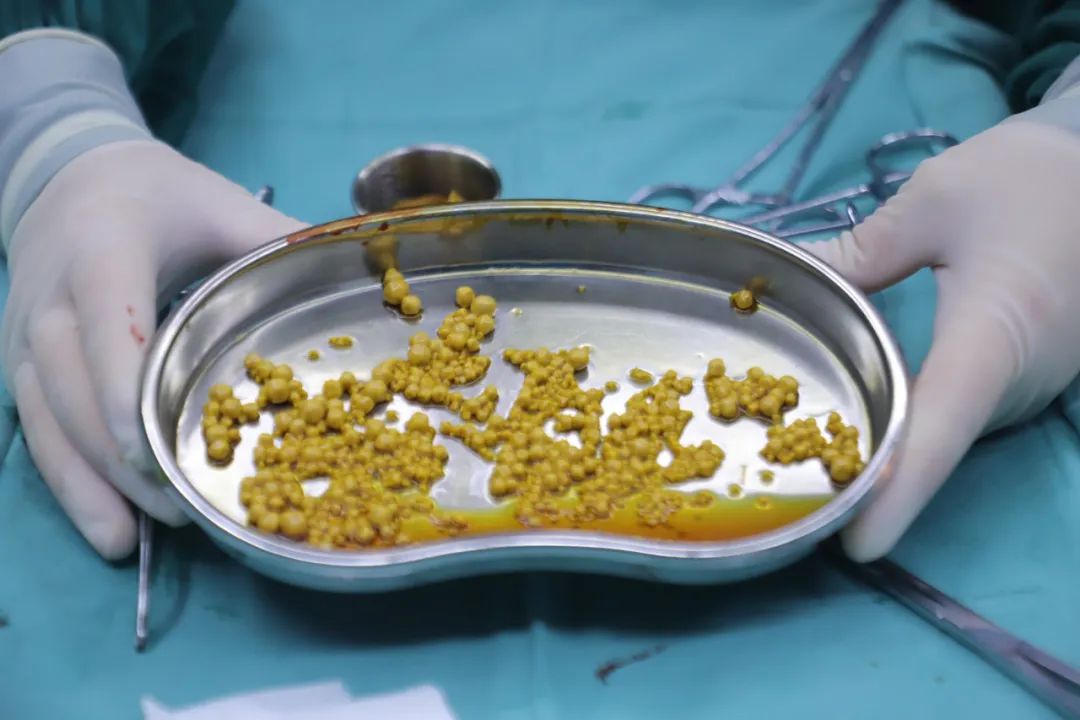 胆结石不痛，为啥还要手术？背后真相很多人不知道 | 四川结石病医院(图2)