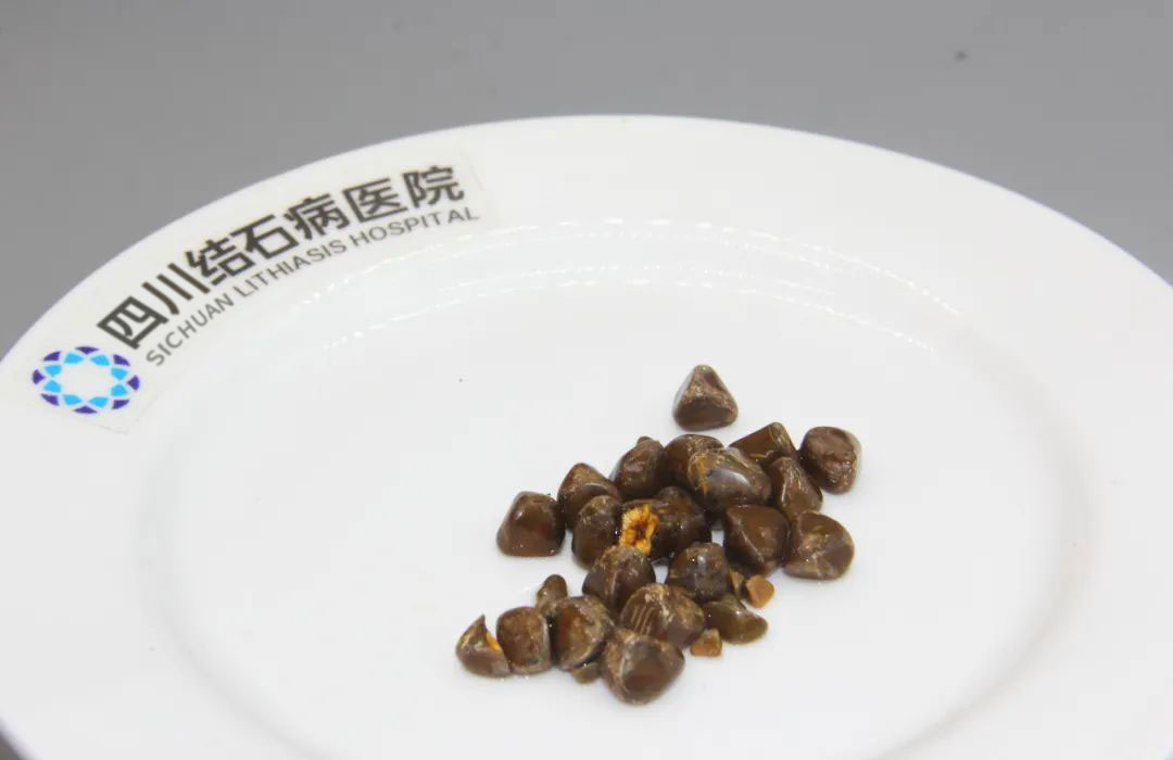 为什么得胆囊结石的人越来越多了?小心这些行为,你可能每天都在做!【四川结石病医院】(图2) 为什么得胆囊结石的人越来越多了?小心这些行为,你可能每天都在做!【四川结石病医院】(图2)