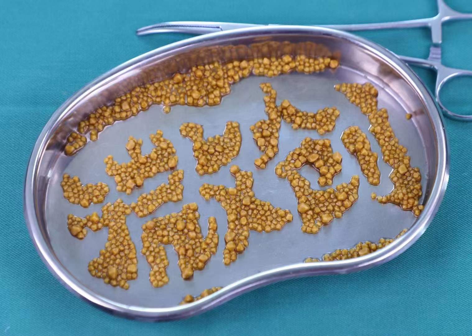 为什么得胆囊结石的人越来越多了?小心这些行为,你可能每天都在做!【四川结石病医院】(图5) 为什么得胆囊结石的人越来越多了?小心这些行为,你可能每天都在做!【四川结石病医院】(图5)